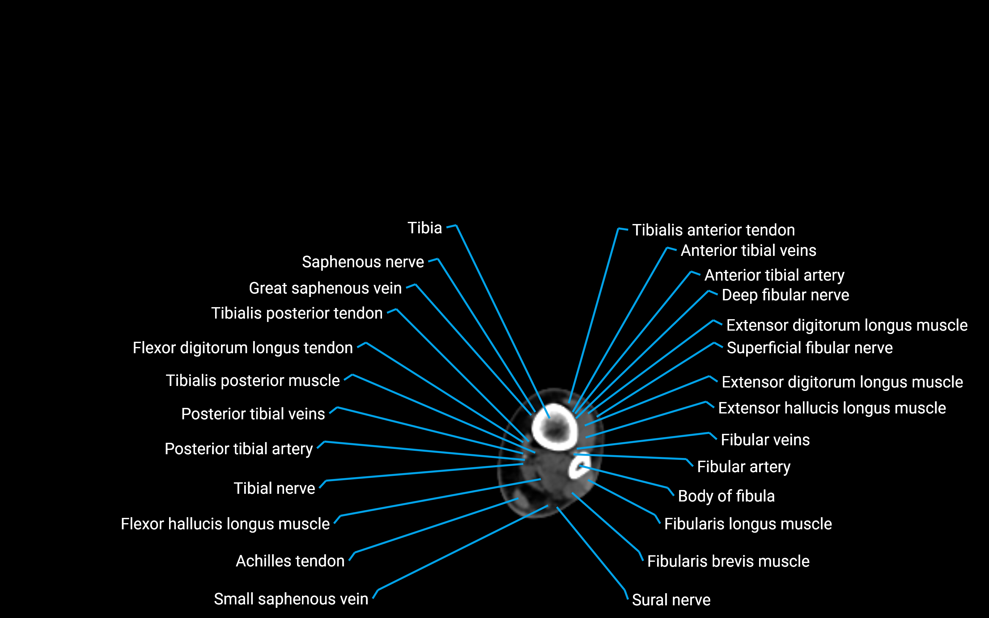 CT Lower leg axial cross sectional anatomy labelled image 157 (2).png